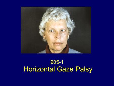 905-1 Horizontal Gaze Palsy. Left esotropia; fascicular sixth nerve palsy, left horizontal gaze palsy.