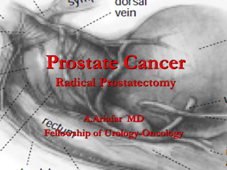 Prostate Cancer Radical Prostatectomy