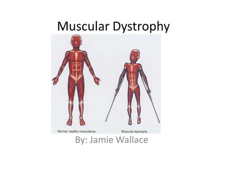 Muscular Dystrophy By: Jamie Wallace.
