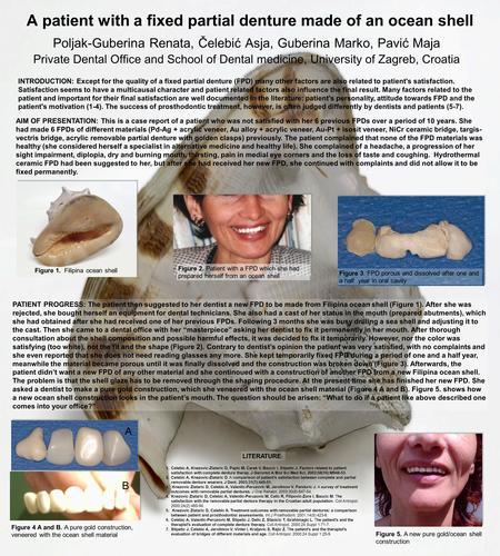 A patient with a fixed partial denture made of an ocean shell Poljak-Guberina Renata, Čelebić Asja, Guberina Marko, Pavić Maja Private Dental Office and.