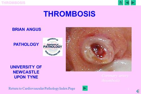 THROMBOSIS 1 BRIAN ANGUS PATHOLOGY UNIVERSITY OF NEWCASTLE UPON TYNE Coronary artery thrombosis Return to Cardiovascular Pathology Index Page.