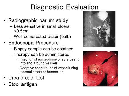 Diagnostic Evaluation Radiographic barium study –Less sensitive in small ulcers 