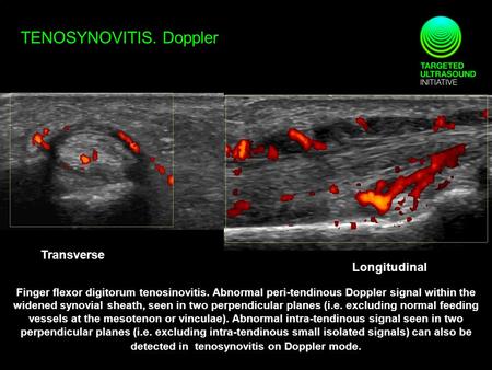 TENOSYNOVITIS. Doppler Transverse Longitudinal Finger flexor digitorum tenosinovitis. Abnormal peri-tendinous Doppler signal within the widened synovial.