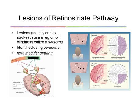 Lesions of Retinostriate Pathway Lesions (usually due to stroke) cause a region of blindness called a scotoma Identified using perimetry note macular sparing.