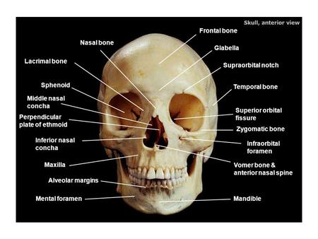Frontal bone Nasal bone Glabella Lacrimal bone Supraorbital notch
