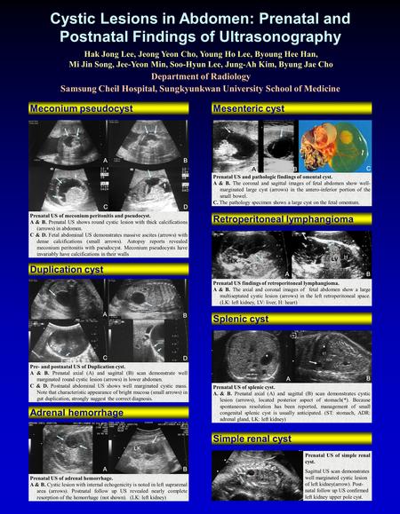 Cystic Lesions in Abdomen: Prenatal and Postnatal Findings of Ultrasonography Duplication cyst Meconium pseudocyst Department of Radiology Samsung Cheil.