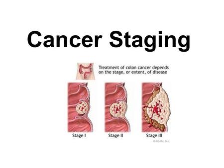 Cancer Staging. What is cancer staging? Staging describes the severity of a person’s cancer based on the extent of the original (primary) tumor and whether.