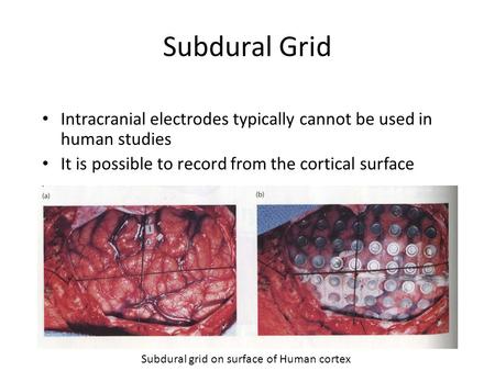 Subdural Grid Intracranial electrodes typically cannot be used in human studies It is possible to record from the cortical surface Subdural grid on surface.