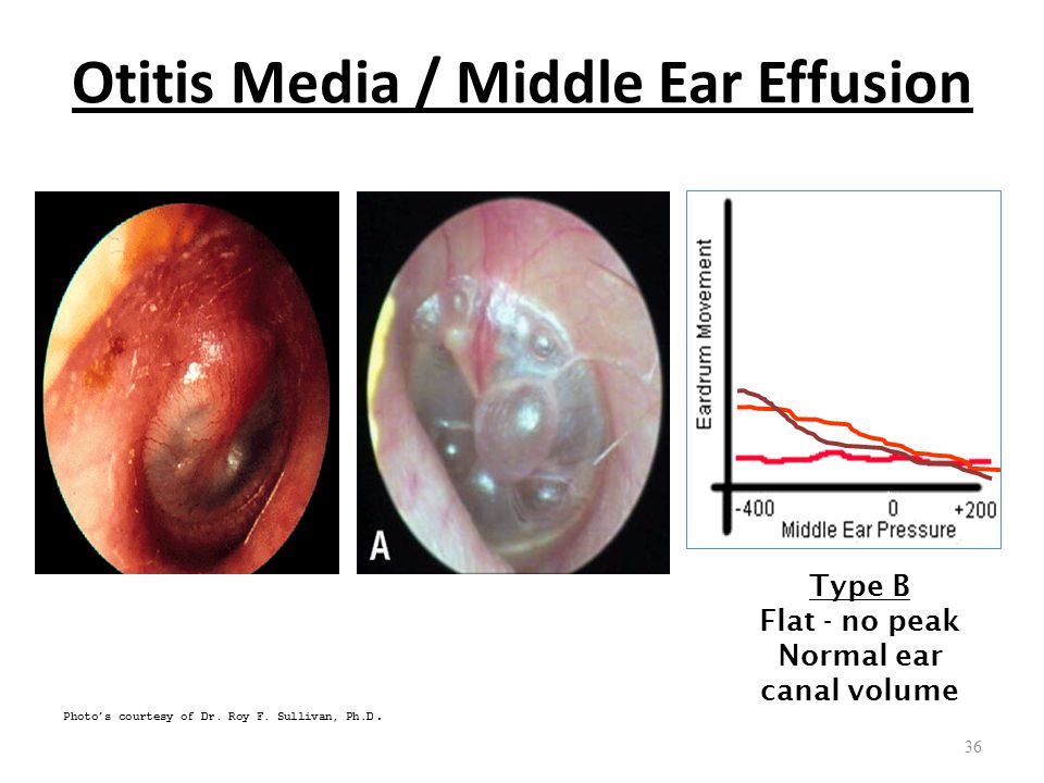 Adult Otitis Media With Effusion 17
