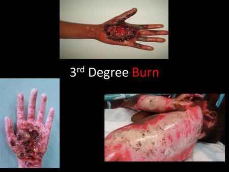 3 rd Degree Burn. Backstory Once upon a time, a boy named Jimmy was just walking along minding his own business. He sensed something around him, but he.