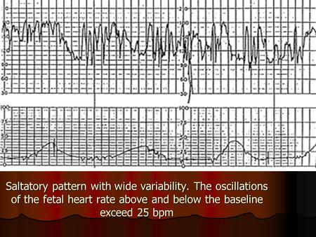 Saltatory pattern with wide variability