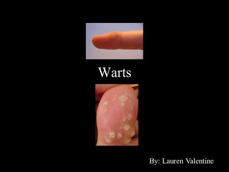 Warts By: Lauren Valentine. A wart is generally a small, rough tumor, typically on hands and feet, that can resemble a cauliflower or a solid blister.