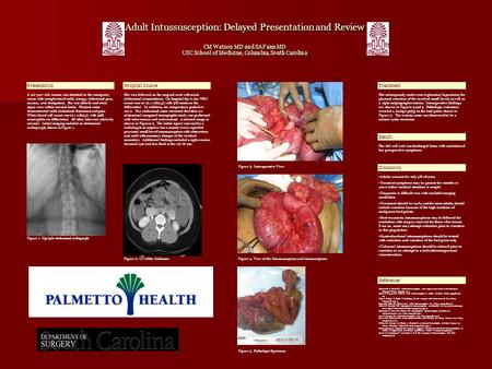 Adult Intussusception: Delayed Presentation and Review CM Watson MD and SA Fann MD USC School of Medicine, Columbia, South Carolina A 40-year-old woman.