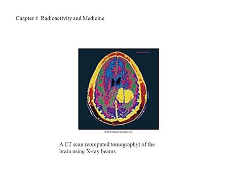 Chapter 4 Radioactivity and Medicine A CT scan (computed tomography) of the brain using X-ray beams.