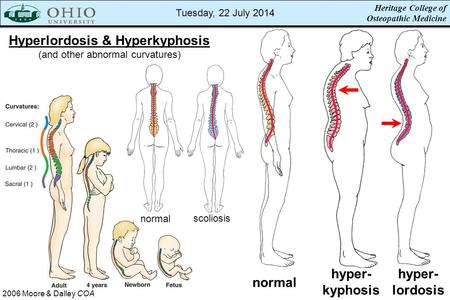 Hyperlordosis & Hyperkyphosis