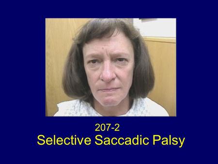 207-2 Selective Saccadic Palsy. Selective Saccadic Palsy after Cardiac Surgery Selective loss of all forms of saccades (voluntary and reflexive quick.