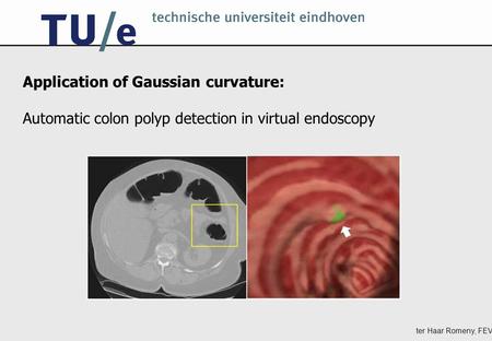 Ter Haar Romeny, FEV Application of Gaussian curvature: Automatic colon polyp detection in virtual endoscopy.