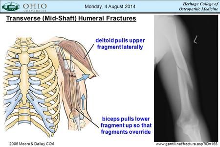 Heritage College of Osteopathic Medicine Transverse (Mid-Shaft) Humeral Fractures 2006 Moore & Dalley COAwww.gentili.net/fracture.asp?ID=165 deltoid pulls.