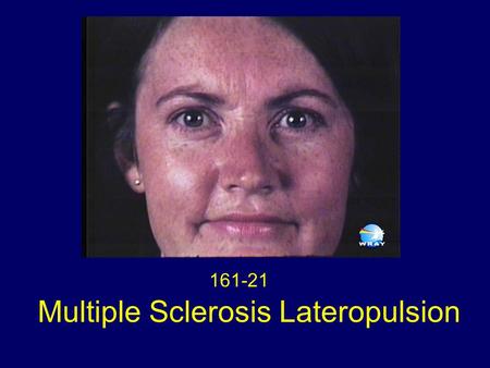 161-21 Multiple Sclerosis Lateropulsion. Lateropulsion (deviation) of the eyes towards the side of the lesion, under closed lids.
