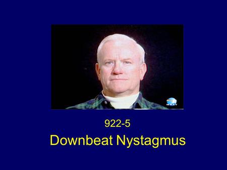 922-5 Downbeat Nystagmus. Idiopathic Downbeat Nystagmus (DBN) No nystagmus in primary gaze Large amplitude slow DBN on gaze right and left Full upgaze,
