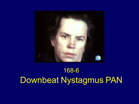 168-6 Downbeat Nystagmus PAN. No nystagmus initially in primary gaze A period of downbeat nystagmus in central gaze A period of periodic alternating nystagmus.