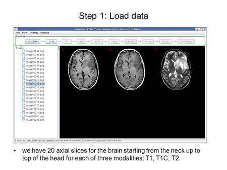 Step 1: Load data we have 20 axial slices for the brain starting from the neck up to top of the head for each of three modalities: T1, T1C, T2.