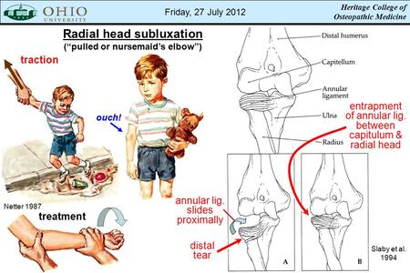 Heritage College of Osteopathic Medicine Radial head subluxation (“pulled or nursemaid’s elbow”) Netter 1987 treatmentouch! traction Slaby et al. 1994.