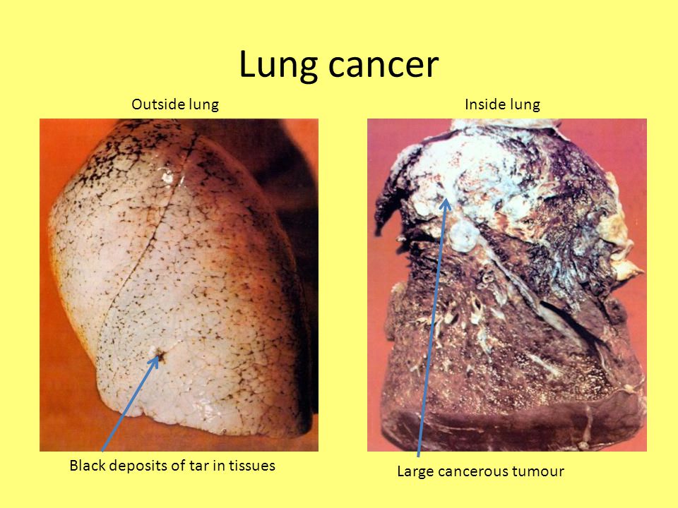 Lung+cancer+Outside+lung+Inside+lung+Bla