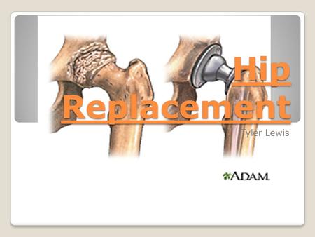 Hip Replacement Tyler Lewis. Symptoms: There are many symptoms when it comes to Hip Replacement including loss in movement of the hips, difficulty walking,