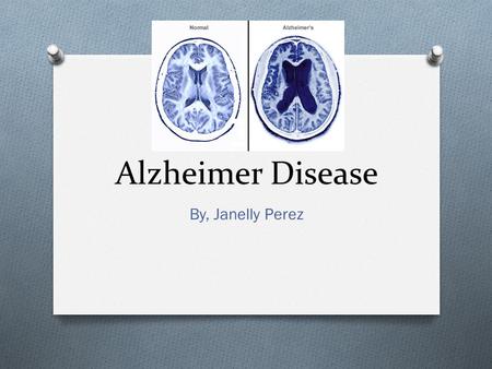 Alzheimer Disease By, Janelly Perez.