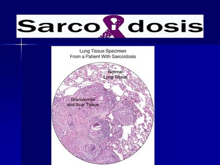 What Is Sarcoidosis ? **Sarcoidosis (sar-koy-DO-sis) is a disease of unknown cause that leads to inflammation. It can affect various organs in the body.