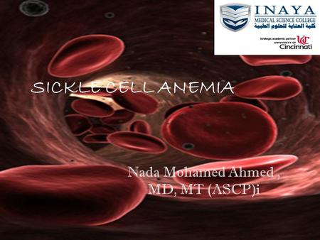 SICKLE CELL ANEMIA Nada Mohamed Ahmed , MD, MT (ASCP)i.