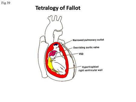 Fig 39 Tetralogy of Fallot.