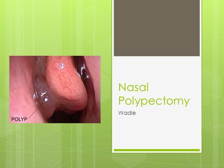 Nasal Polypectomy Wadie.