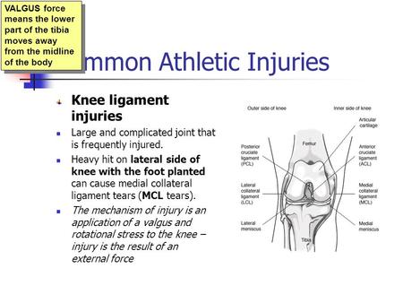 Common Athletic Injuries Knee ligament injuries Large and complicated joint that is frequently injured. Heavy hit on lateral side of knee with the foot.