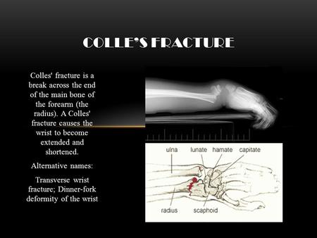 Transverse wrist fracture; Dinner-fork deformity of the wrist