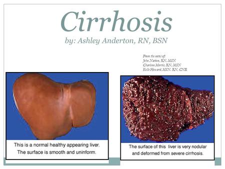 Cirrhosis by: Ashley Anderton, RN, BSN