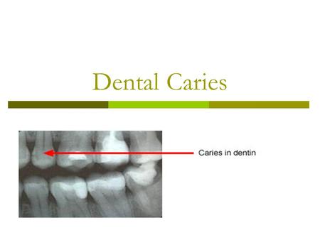 Dental Caries. Dental caries destroy the mineral component of teeth, causing decay.