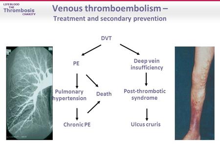 LIFEBLOOD THE Thrombosis CHARITY Venous thromboembolism – Treatment and secondary prevention Ulcus cruris Chronic PE PE DVT Post-thrombotic syndrome Death.