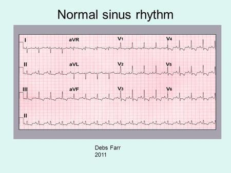 Normal sinus rhythm Debs Farr 2011.