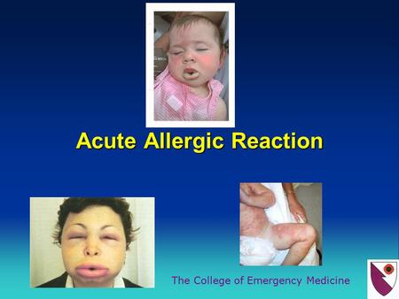 The College of Emergency Medicine Acute Allergic Reaction.