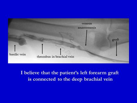 Graft venous anastomosis thrombus in brachial vein basilic vein I believe that the patient’s left forearm graft is connected to the deep brachial vein.