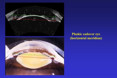 Phakic cadaver eye (horizontal meridian). Pseudophakic cadaver eye (horizontal meridian)