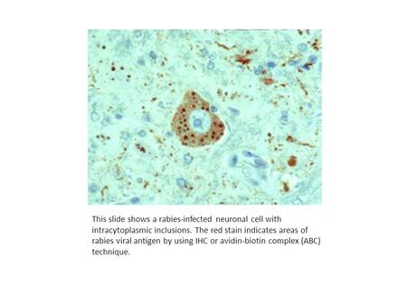 This slide shows a rabies-infected neuronal cell with intracytoplasmic inclusions. The red stain indicates areas of rabies viral antigen by using IHC or.