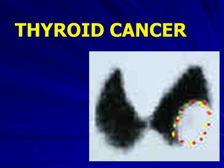 THYROID CANCER.