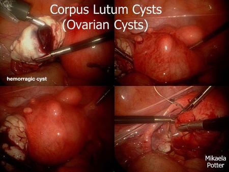 Corpus Lutum Cysts (Ovarian Cysts)