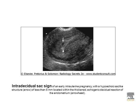 Intradecidual sac sign of an early intrauterine pregnancy, with a hypoechoic saclike structure (arrow) of less than 5 mm located within the thickened,