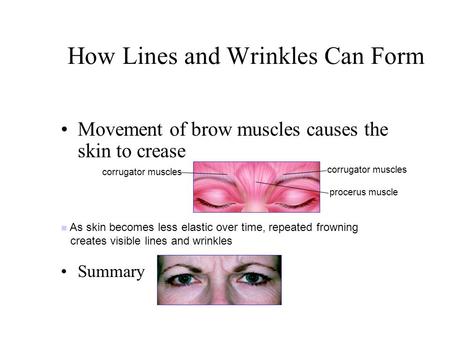 How Lines and Wrinkles Can Form Movement of brow muscles causes the skin to crease Summary corrugator muscles procerus muscle As skin becomes less elastic.