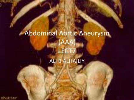 Abdominal Aortic Aneurysm (AAA) LECT7 ALI B ALHAILIY.