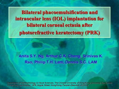 Bilateral phacoemulsification and intraocular lens (IOL) implantation for bilateral corneal ectasia after photorefractive keratectomy (PRK) Department.